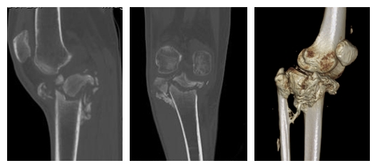 2膝关节术前CT片.jpg