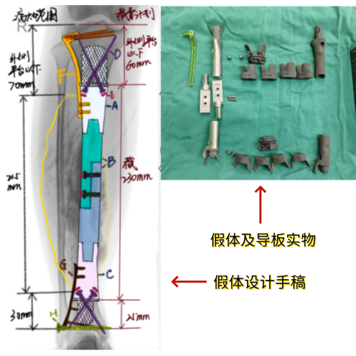 骨肿瘤新闻（改）1008_副本1.png